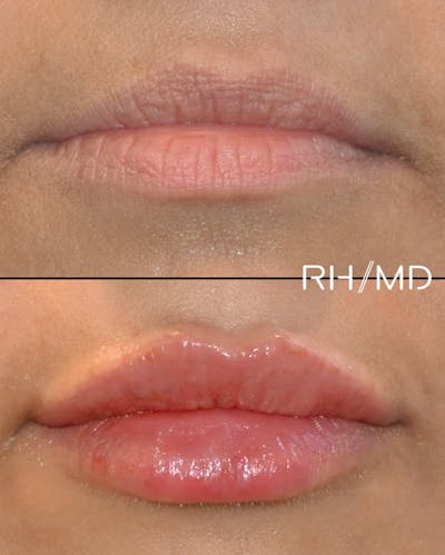 Procedures Before & After Gallery - Patient 366947 - Image 1
