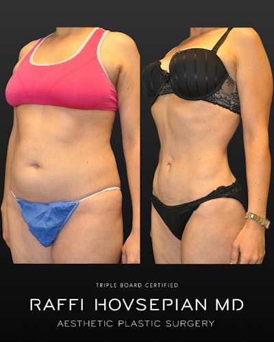 Procedures Before & After Gallery - Patient 391663 - Image 1