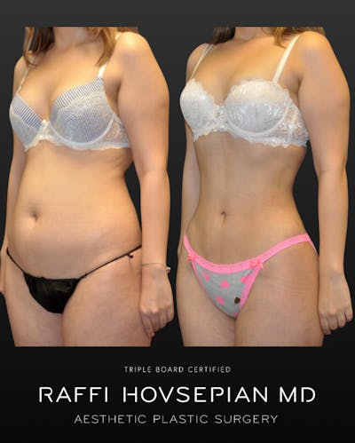 Procedures Before & After Gallery - Patient 995272 - Image 1