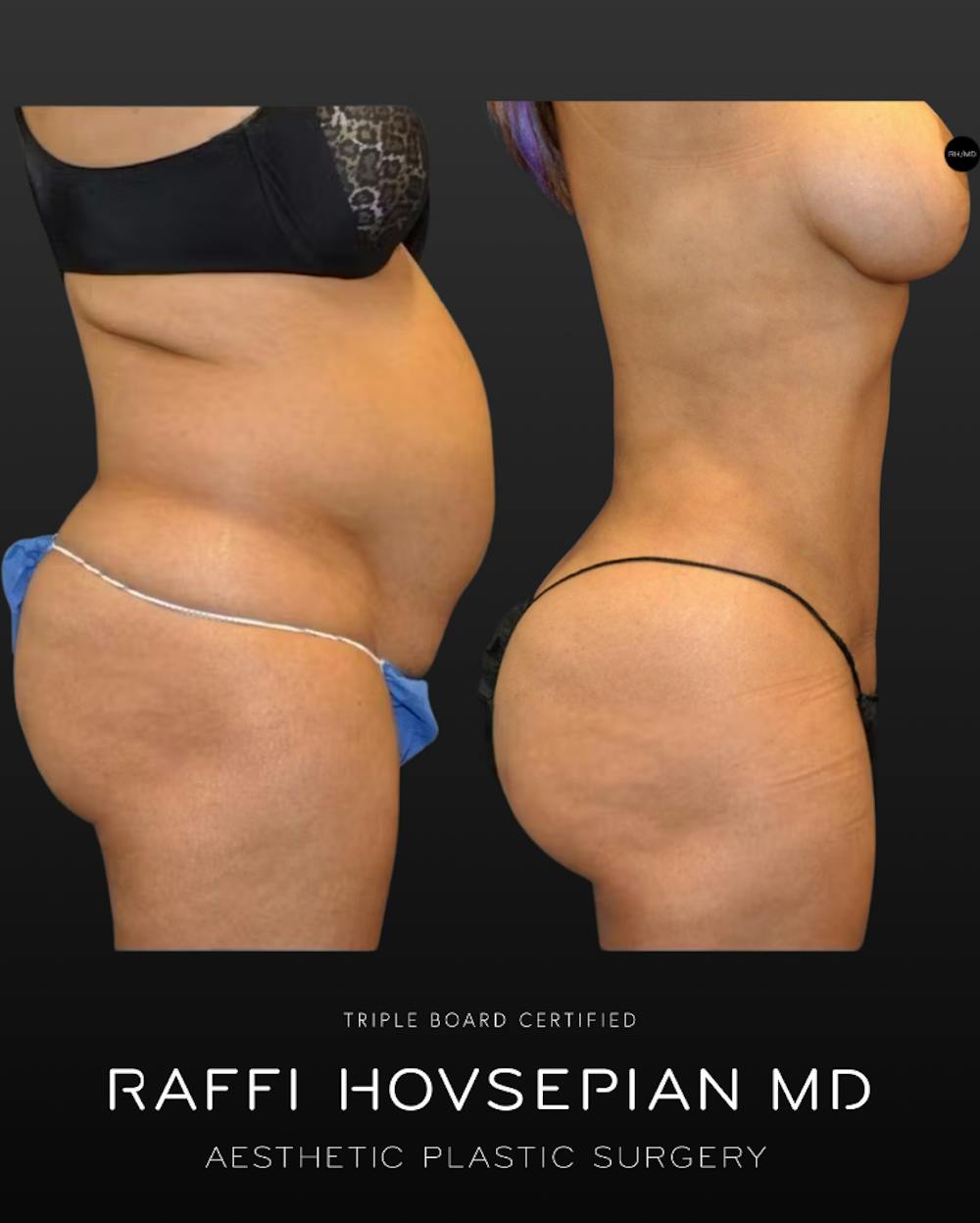 Procedures Before & After Gallery - Patient 188327 - Image 1