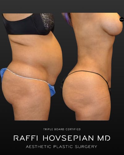 Procedures Before & After Gallery - Patient 188327 - Image 1