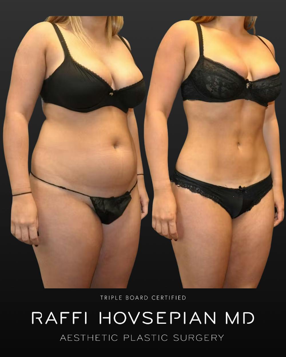 Procedures Before & After Gallery - Patient 165348 - Image 1
