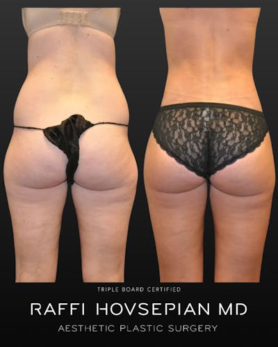 Procedures Before & After Gallery - Patient 160709 - Image 1