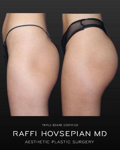 Procedures Before & After Gallery - Patient 242109 - Image 1