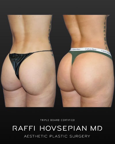 Procedures Before & After Gallery - Patient 337413 - Image 1