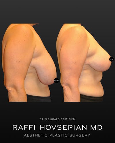 Procedures Before & After Gallery - Patient 288788 - Image 1