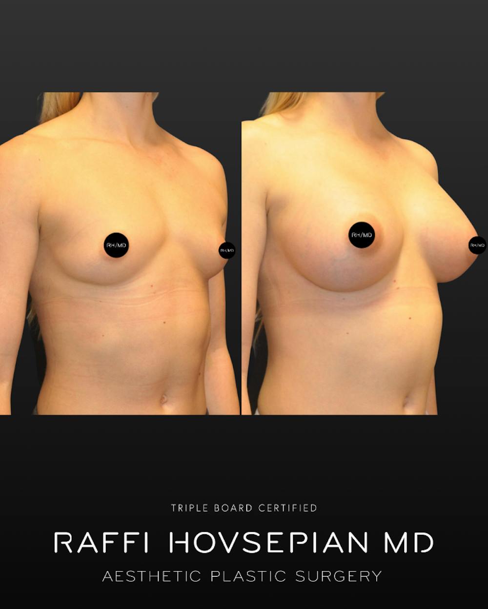 Procedures Before & After Gallery - Patient 126368 - Image 1