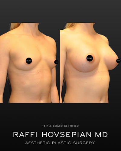 Procedures Before & After Gallery - Patient 126368 - Image 1