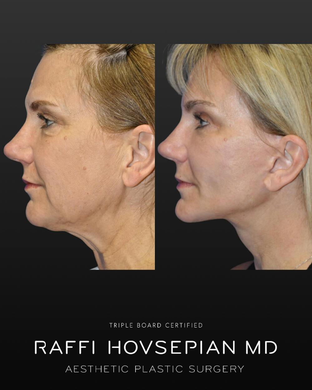 Procedures Before & After Gallery - Patient 117552 - Image 1