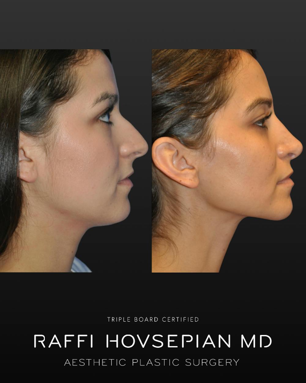 Procedures Before & After Gallery - Patient 178392 - Image 1