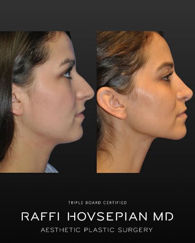 Procedures Before & After Gallery - Patient 178392 - Image 1