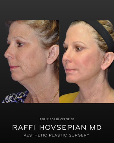 Procedures Before & After Gallery - Patient 435018 - Image 1