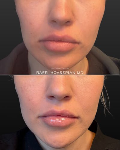 Procedures Before & After Gallery - Patient 260416 - Image 1