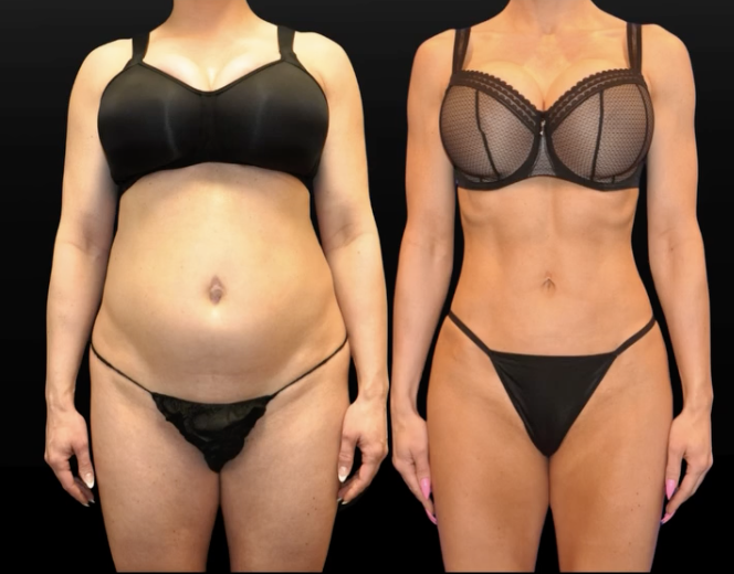 Raffi Hovsepian, MD Blog | Lipo 360: Is It Worth It for a Full-Torso Transformation?