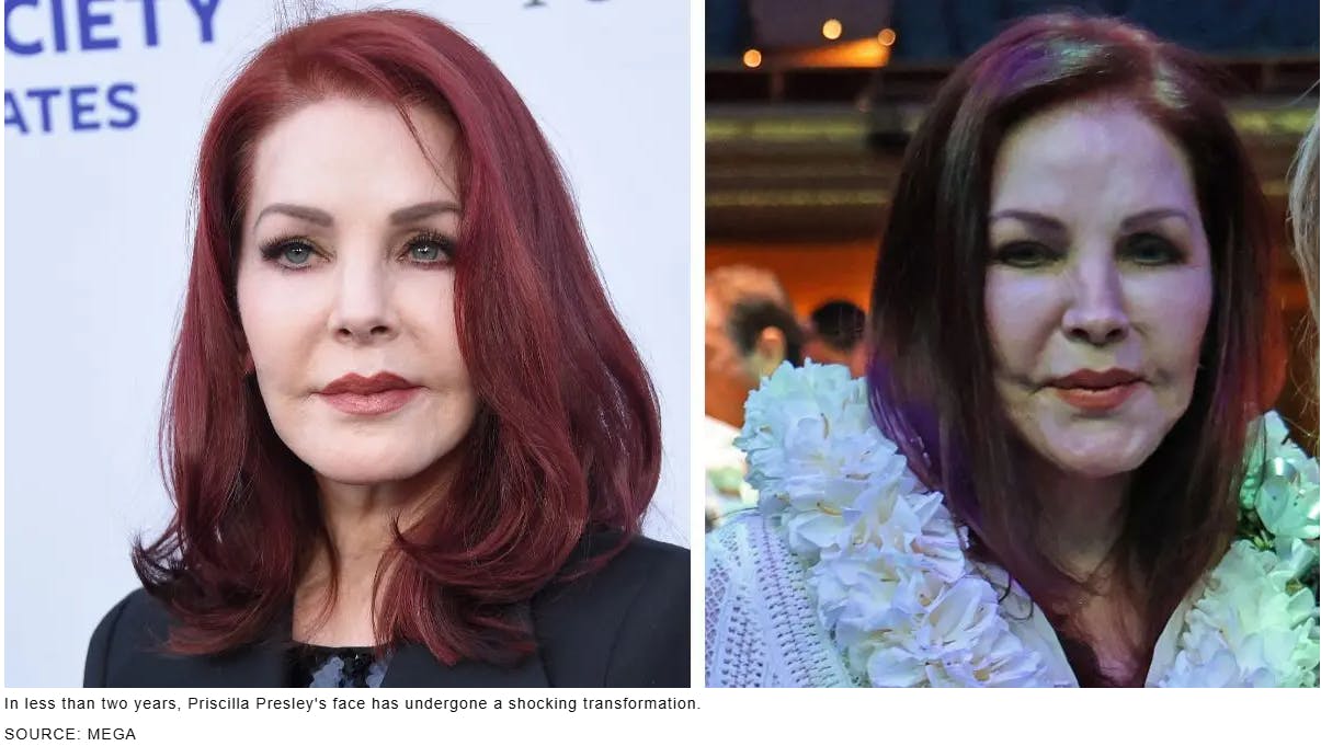 Raffi Hovsepian, MD Blog | Dr. Raffi Hovsepian Weighs In and Explains Priscilla Presley's 'Lumpy' Look