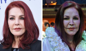 Raffi Hovsepian, MD Blog | Dr. Raffi Hovsepian Weighs In and Explains Priscilla Presley's 'Lumpy' Look