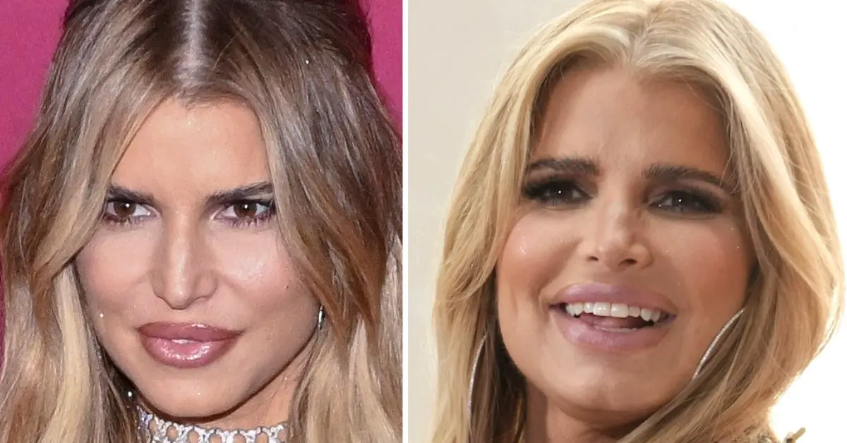 Raffi Hovsepian, MD Blog | Plastic Surgery Disaster: Jessica Simpson's 'Exaggerated'  Face the Result of Mid-face Fillers Leaving Her 'Overcorrected' With Expressions 'Firmer or Less  Dynamic'  , Top Plastic Surgeon Claims