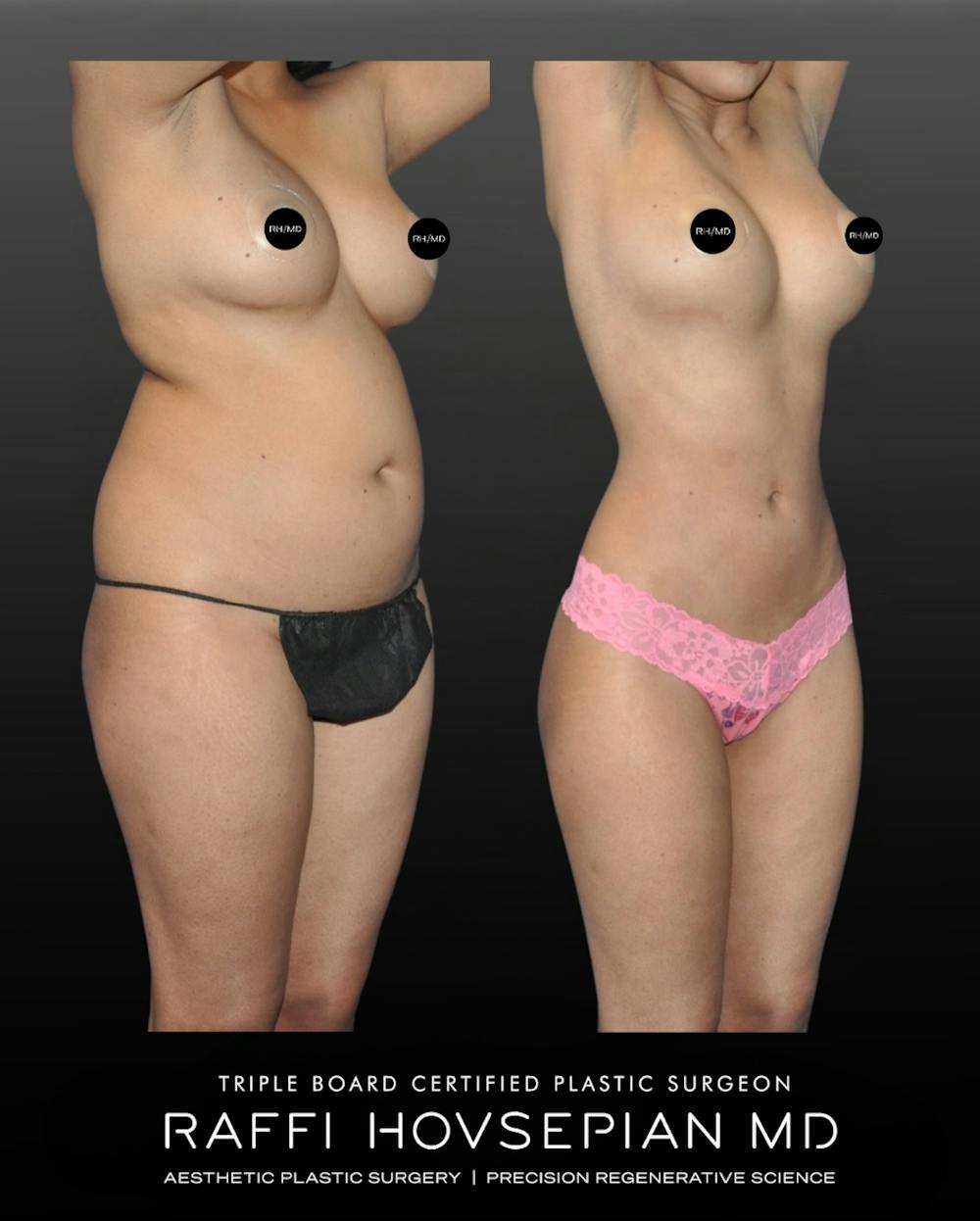 Procedures Before & After Gallery - Patient 187016 - Image 1