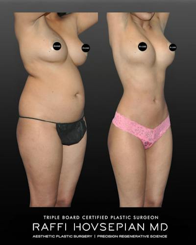 Procedures Before & After Gallery - Patient 187016 - Image 1
