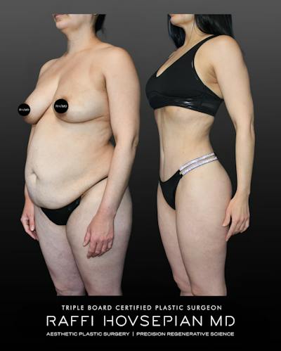 Procedures Before & After Gallery - Patient 389713 - Image 1