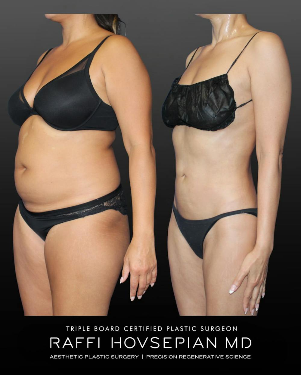 Procedures Before & After Gallery - Patient 354966 - Image 1