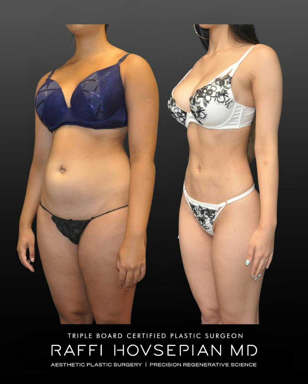 Procedures Before & After Gallery - Patient 419222 - Image 1