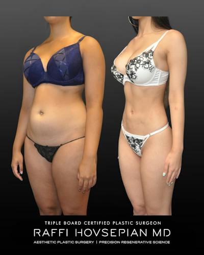Procedures Before & After Gallery - Patient 419222 - Image 1