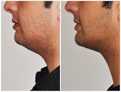 Chin Implants Before & After Gallery - Patient 30624073 - Image 1