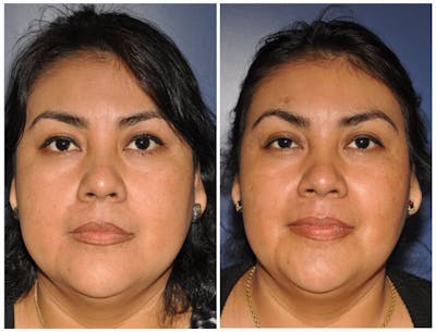 Chin Implants Before & After Gallery - Patient 30624074 - Image 1