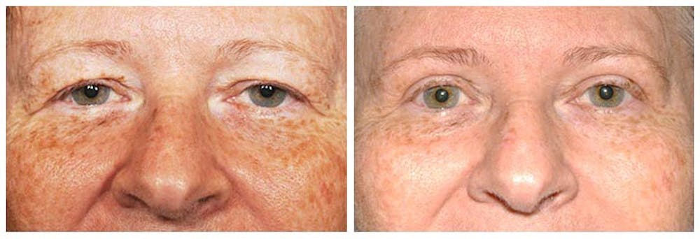 Upper Eyelids Before & After Gallery - Patient 30624081 - Image 1