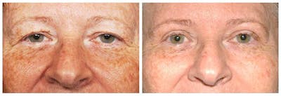 Upper Eyelids Before & After Gallery - Patient 30624081 - Image 1
