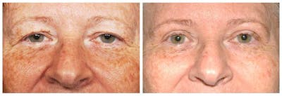 Upper Eyelids Before & After Gallery - Patient 30624081 - Image 1