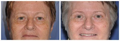 Upper Eyelids Before & After Gallery - Patient 30624081 - Image 2