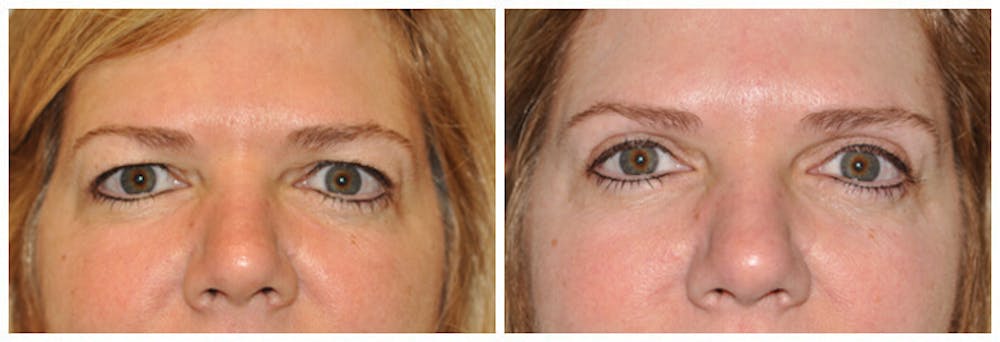 Upper Eyelids Before & After Gallery - Patient 30624084 - Image 1