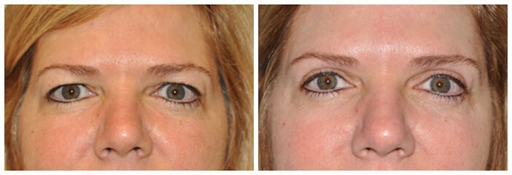 Upper Eyelids Before & After Gallery - Patient 30624084 - Image 1