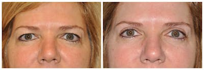 Upper Eyelids Before & After Gallery - Patient 30624084 - Image 1