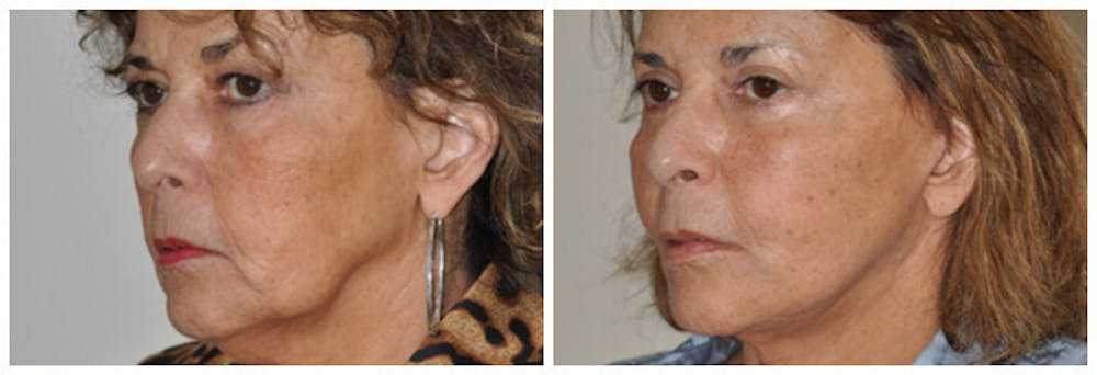 Upper Eyelids Before & After Gallery - Patient 30624085 - Image 1