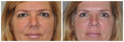 Upper Eyelids Before & After Gallery - Patient 30624084 - Image 2
