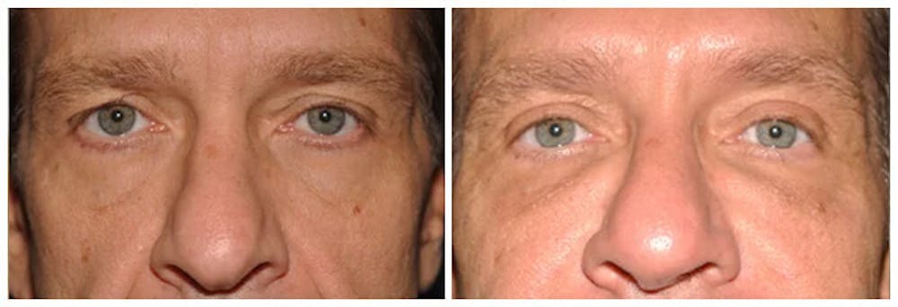 Upper Eyelids Before & After Gallery - Patient 30624086 - Image 1