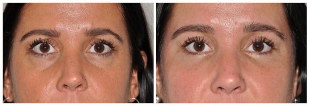 Lower Eyelids Before & After Gallery - Patient 30624091 - Image 1