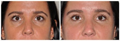 Lower Eyelids Before & After Gallery - Patient 30624091 - Image 1