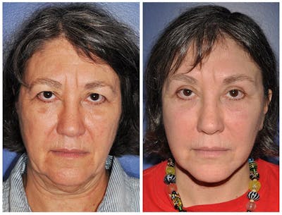 Facelift Before & After Gallery - Patient 30624095 - Image 1