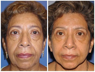 Facelift Before & After Gallery - Patient 30624096 - Image 1