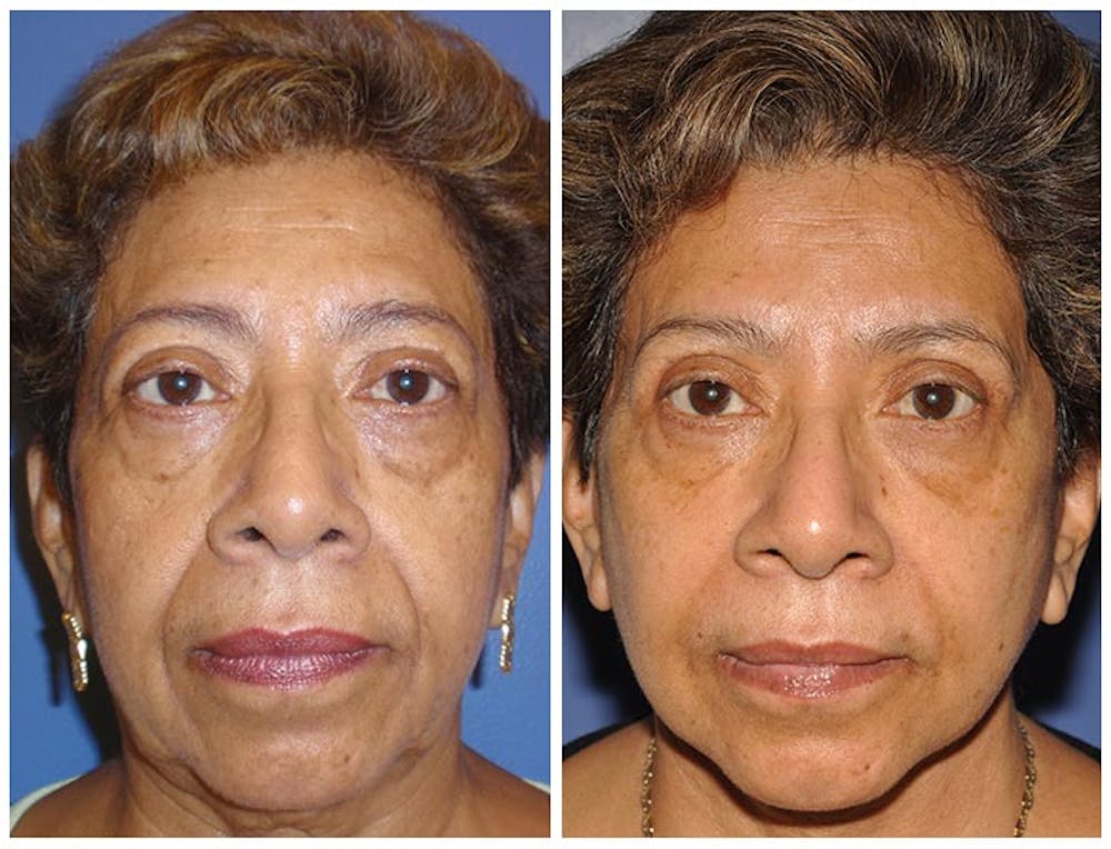 Facelift Before & After Gallery - Patient 30624096 - Image 1