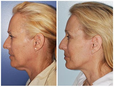 Facelift Before & After Gallery - Patient 30624097 - Image 1