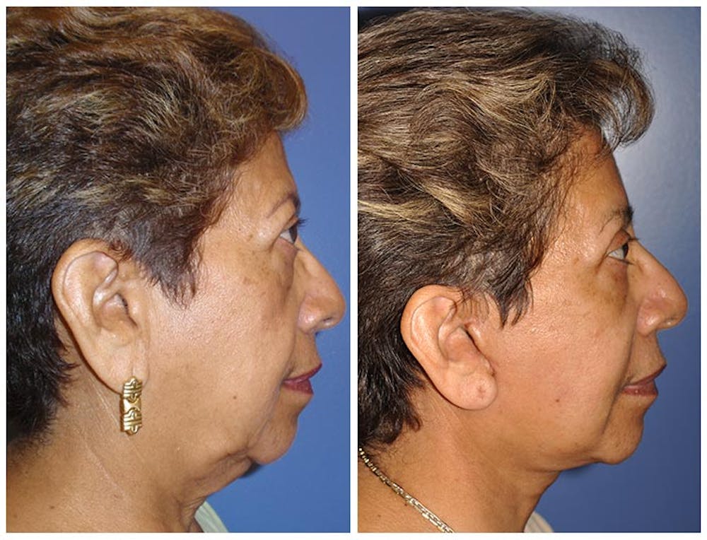 Facelift Before & After Gallery - Patient 30624096 - Image 3