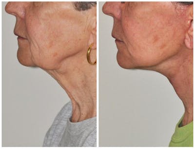 Facelift Before & After Gallery - Patient 30624098 - Image 1