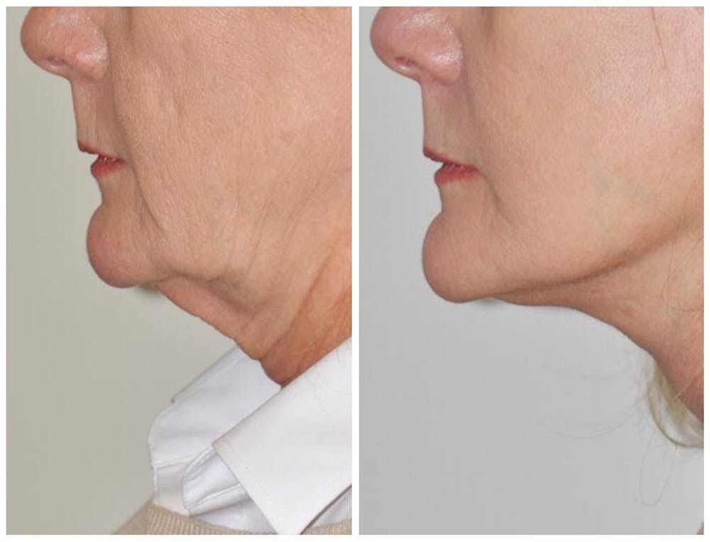 Facelift Before & After Gallery - Patient 30624099 - Image 1