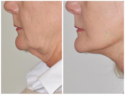 Facelift Before & After Gallery - Patient 30624099 - Image 1