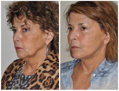 Facelift Before & After Gallery - Patient 30624100 - Image 1